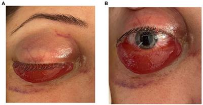 Uncommon association between vascular Ehlers–Danlos syndrome and ocular complications